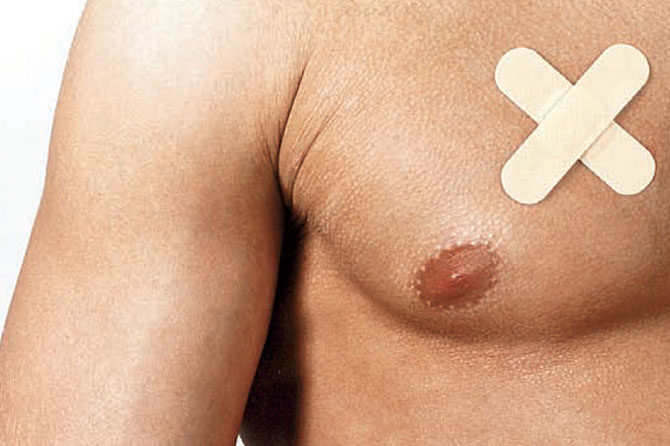 Rak dojk pri moškem – Pogosto ga odkrijejo z zamudo