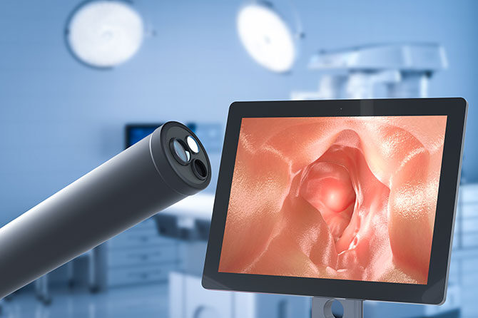 Prebavila: Kolonoskopija – Vse, o čemer si niste upali vprašati