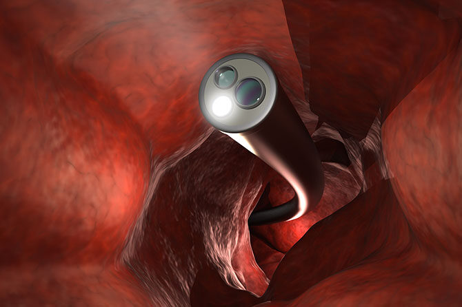 Anestezija – Kolonoskopija brez bolečin