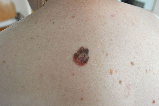 Melanom – ta nevaren kožni rak je v zgodnji fazi ozdravljiv