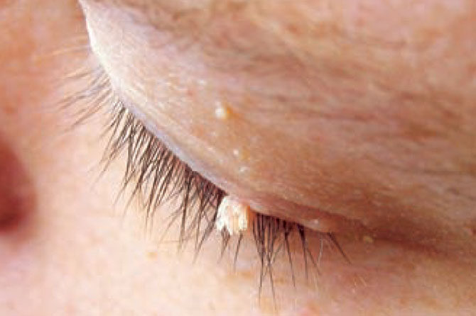 Virusne bradavice – pogosta, a nenevarna okužba