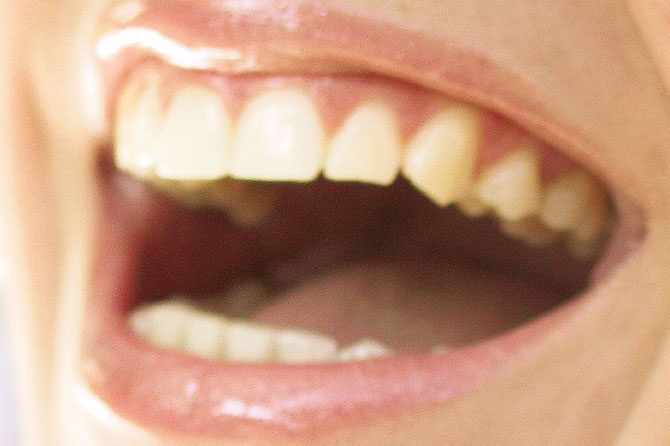 Nadomeščanje manjkajočih zob