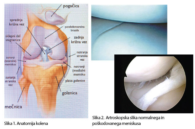 Poškodbe kolena – Artroskopsko zdravljenje znotrajsklepnih poškodb