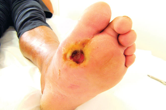 Sladkorna bolezen – prekrvavitev, okvare živčevja…