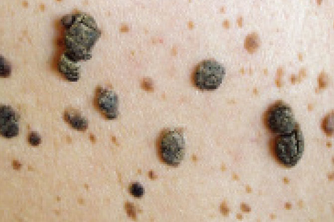 Starostne bradavice – Zelo pogoste kožne tvorbe v drugi polovici življenja