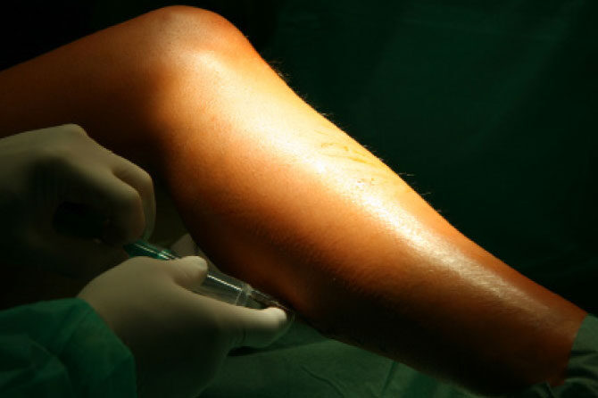 Kronična venska bolezen je v sodobnem svetu zelo pogosta