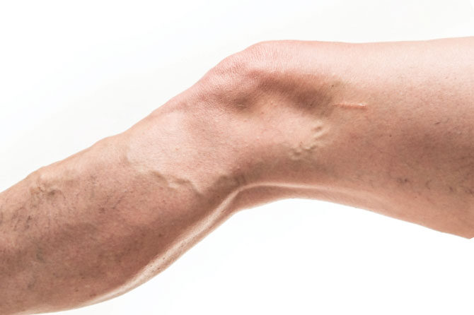 Kdaj k angiologu in kdaj k flebologu