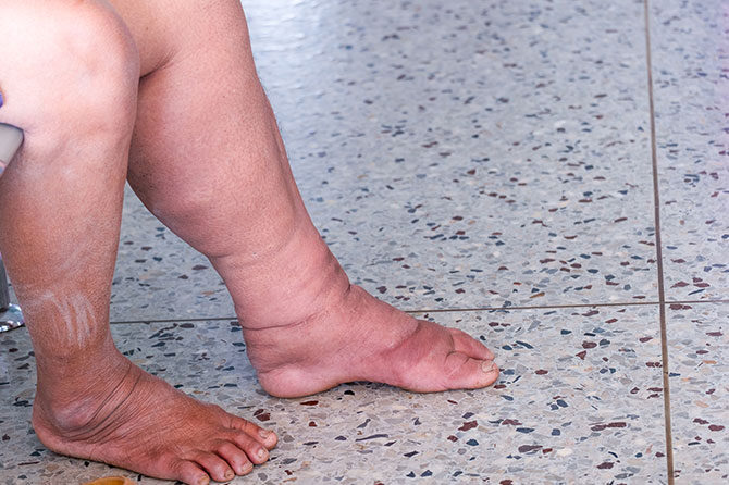 Oteklina je znak za alarm