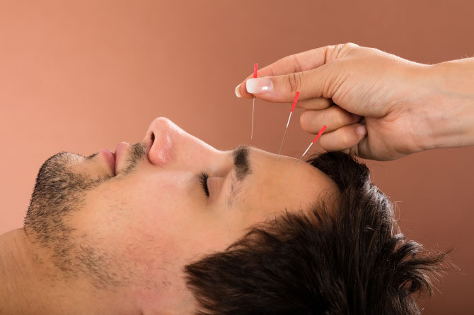 Akupunktura za zdravljenje migrene