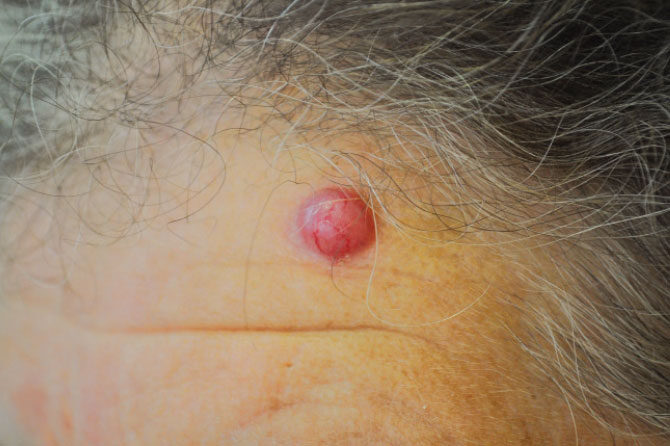 Kožni rak – Z njim se bo srečal vsak peti prebivalec Evrope