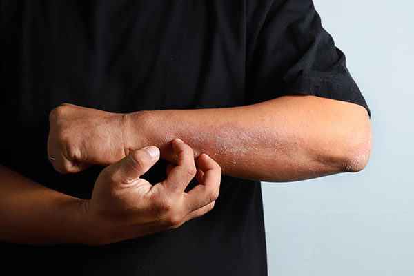 Doktor odgovarja: Atopijski dermatitis