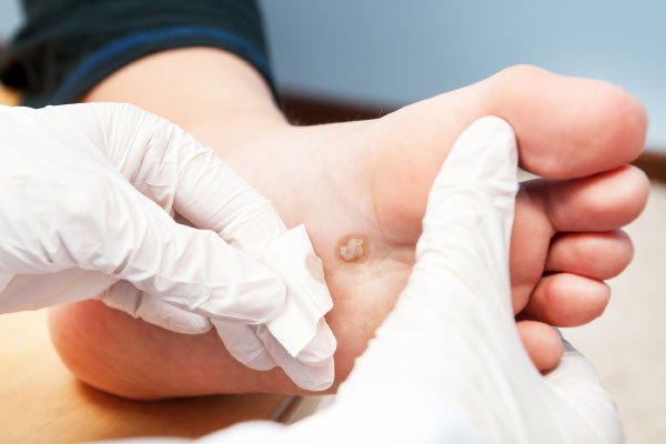 Bradavice – Neprijetni, a večinoma nenevarni izrastki