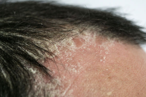 Luskavica ni samo bolezen kože