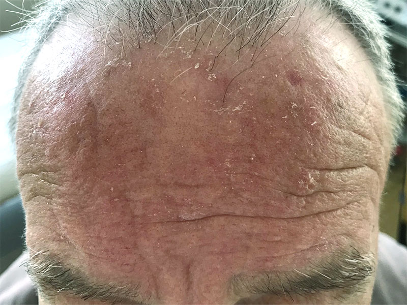 Aktinične keratoze na čelu