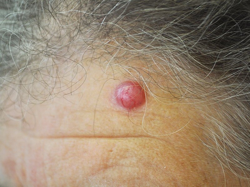 Bazalnocelični karcinom na čelu