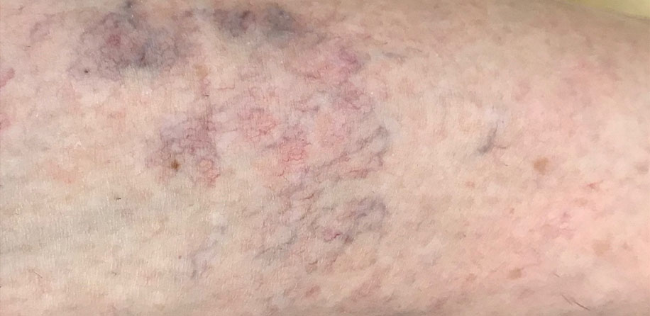 Pajkaste vene pred posegom