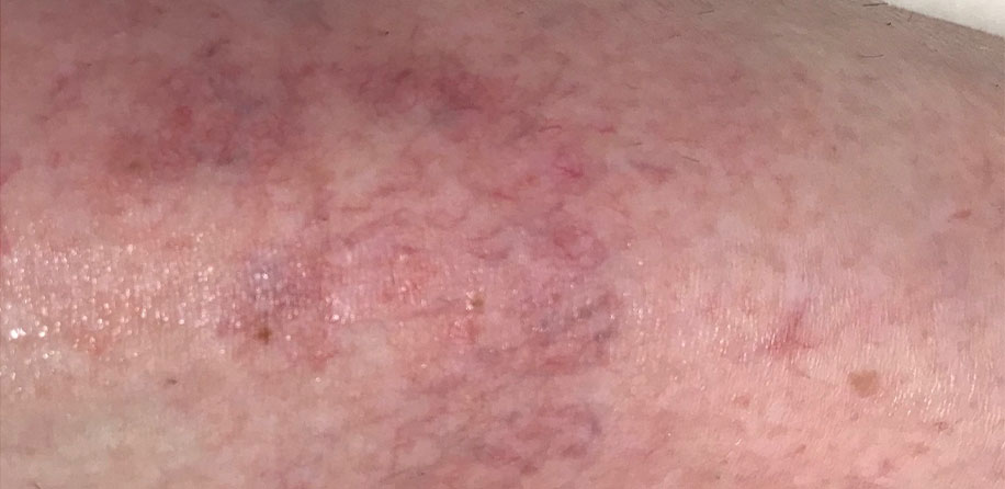 Pajkaste vene takoj po posegu