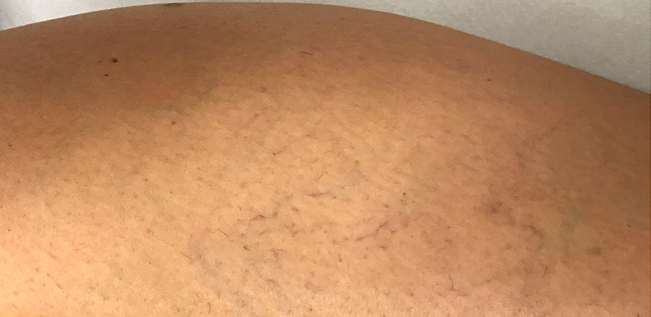 Pajkaste žilice na goleni