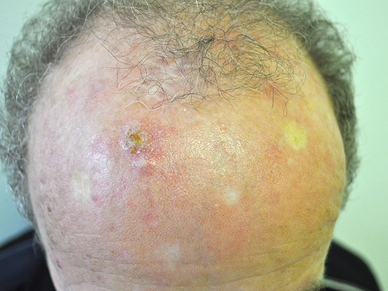 Ploščatocelični karcinom na neporaščenem lasišču desno