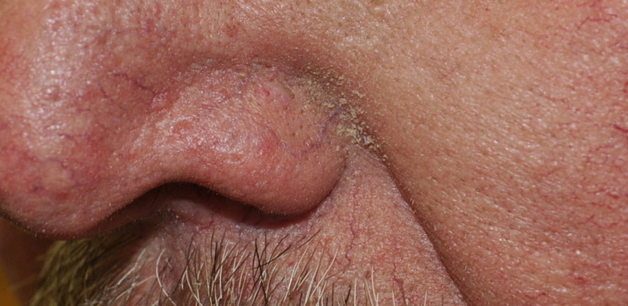 Seboroični dermatitis