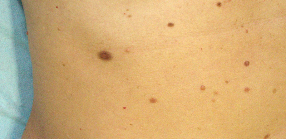 Nenevarna pigmentna znamenja
