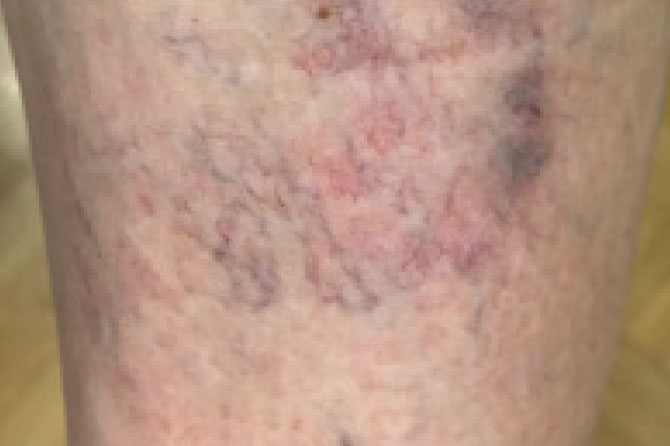 Lasersko odstranjevanje pajkastih ven na nogah