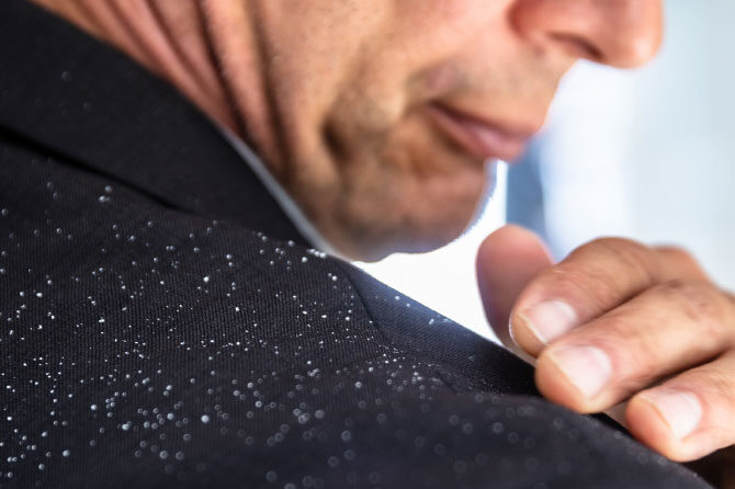 V večini primerov problem lahko rešimo s šamponom