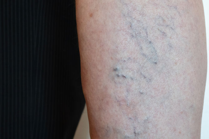 Periferna arterijska bolezen