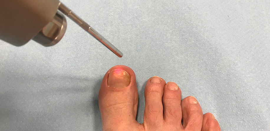 Lasesko zdravljenje onihomikoze