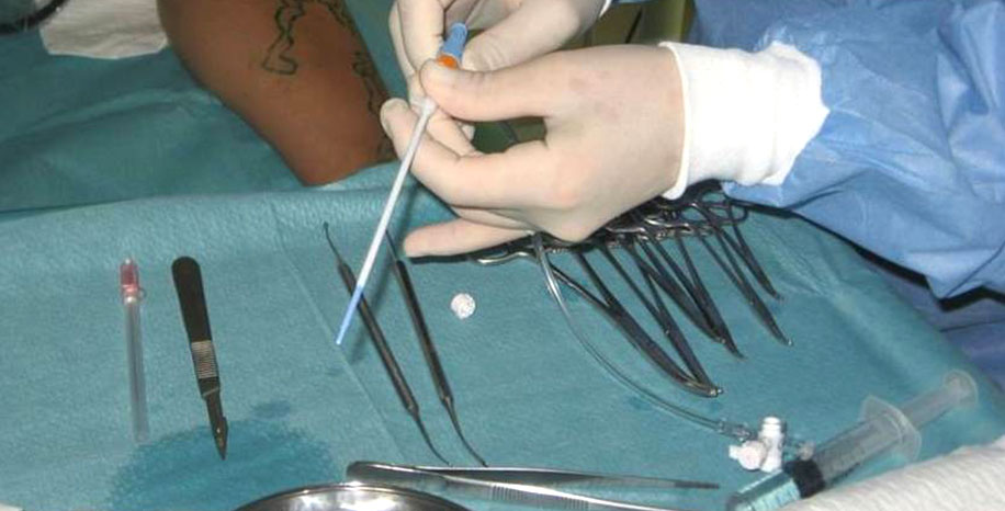 RFA – endovenska radiofrekvenčna ablacija