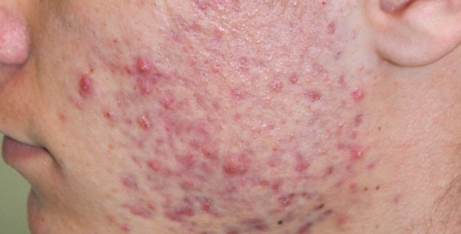 Akne