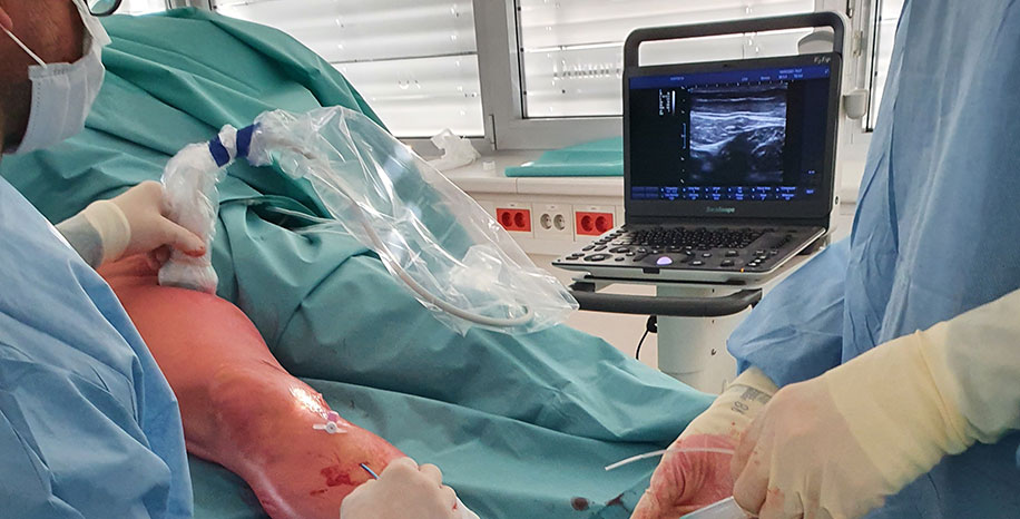 NTNT – netermalna, netumescentna endovenska ablacija