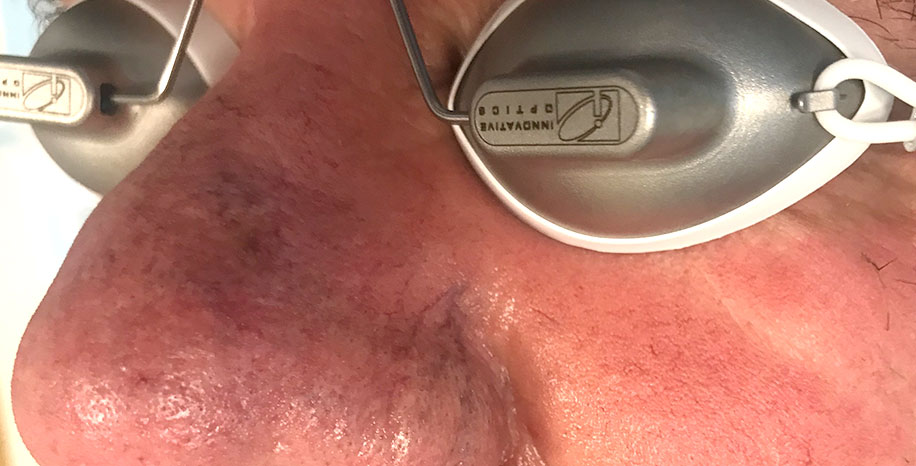 Razširjene žilice na obrazu