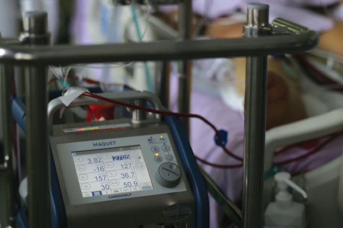 Metoda ECMO lahko rešuje življenja