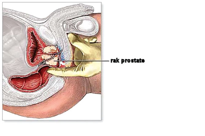 Rak prostate 1