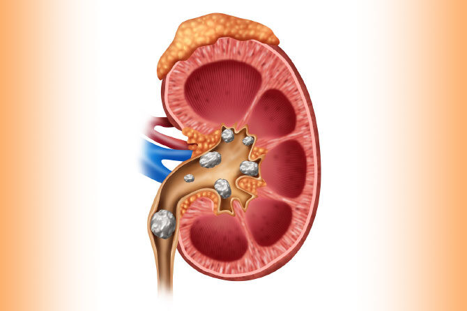 Sečni kamni – Ko sečila zahtevajo kamnolom