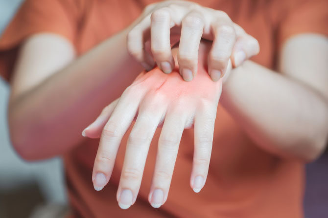 Dermatitisi – Zoprni vnetni izpuščaji na koži