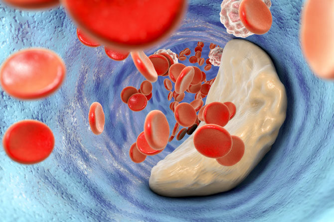 Holesterol – Še najbolj pomaga zdravo življenje