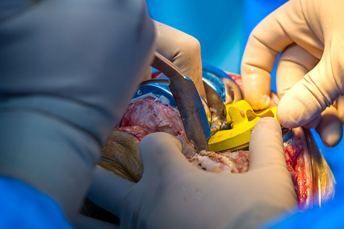 Kaj je artroza in kako jo zdraviti – od fizioterapije do vstavitve umetnega sklepa