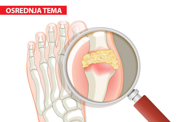 Putika  – še vedno bolezen bogatih?